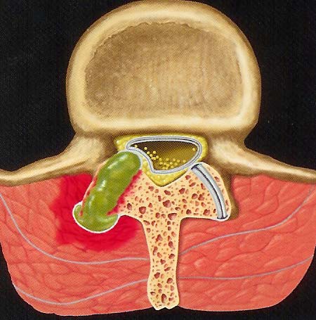 Facet synovial cyst.jpg